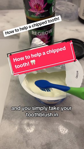 How to help a chipped tooth! 🦷 I would like to say the words “how to heal a chipped tooth” but I’ve learned people dont like that. This is my 3-4 step process. Use Regrow teeth remineralizeing powder, Calc phos. and Calc Flour cell salts . Disclosure: I am a mom. Not a dentist. . #homeopathyremedies #holistichealing #naturalcures #homeopathicremedy #chippedtooth #chippedteeth #remineralizingtoothpaste #toothremineralization