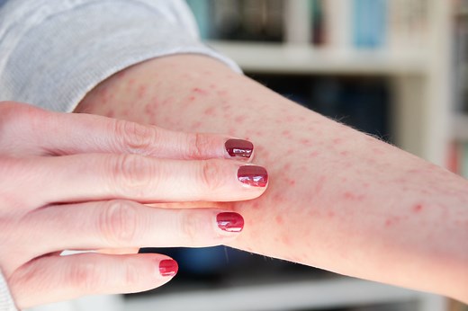These Pictures of Skin Rashes Will Help You Quickly Identify Them