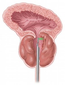GreenLight Laser Therapy - Alchetron, the free social encyclopedia