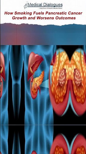 How Smoking Fuels Pancreatic Cancer Growth and Worsens Outcomes