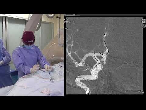 Transradial Stent-Assist Coil Embolization of an Anterior Communicating Artery (ACOM) Brain Aneurysm