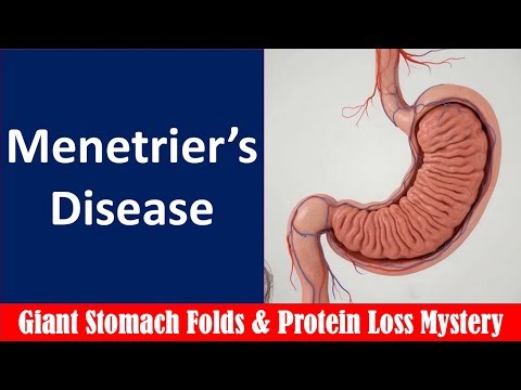 Menetrier’s Disease Explained Giant Stomach Folds & The Protein Loss Mystery