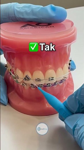 Jak nitkować zęby w aparacie #dentysta #aparatortodontyczny #dentalblue