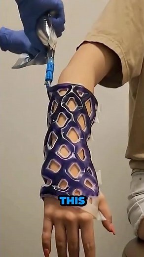 Broken Arm This Cast Changes Everything!