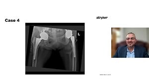 Simplifying Revision Hip