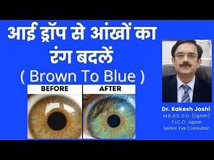 Eye color change by eye drops from brown to blue. .