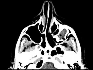 Odontogenic Ossifying Fibroma