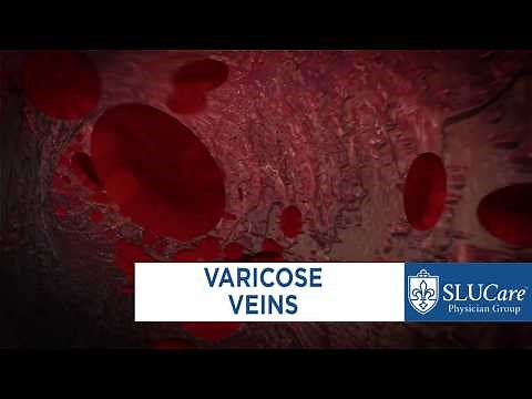 Treating Varicose Veins - SLUCare Vascular Surgery