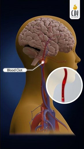 How Are Blood Clots Removed #tpa #minimalinvasive #3dvideo