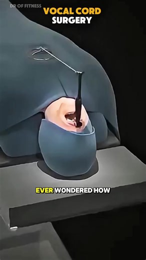 How Vocal Cord Surgery (3D Animation) Vocal cord surgery is performed to treat conditions such as nodules, polyps, cysts, or tumors affecting the vocal folds. Using a laryngoscope inserted through the mouth, surgeons access the vocal cords without external incisions. Precise microsurgical instruments or lasers are used to remove abnormal tissue while preserving healthy structures to maintain voice quality. #vocalcordsurgery #laryngology #ent #medical3d #3danimation