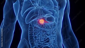 Animation of a malignant tumor in a man's pancreas