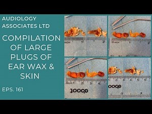 COMPILATION OF LARGE PLUGS OF EAR WAX & SKIN - EP161