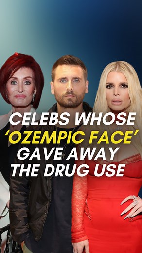 In Hollywood, smooth, plump cheeks and wrinkle-free foreheads have long been considered the gold standard of beauty. However, a new trend is emerging characterized by sunken eyes, gaunt cheeks, and saggy skin. This phenomenon, often referred to as "Ozempic face," is attributed to the rising popularity of weight-loss drugs. Here are six celebrities whose dramatic transformations due to weight loss and changes in facial features have been linked to Ozempic. #jessicasimpson #sharonosbourne #scottdi