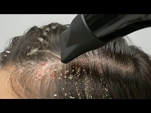 Amazing Scalp Transformation: From Dry & Flaky to Healthy & Clean