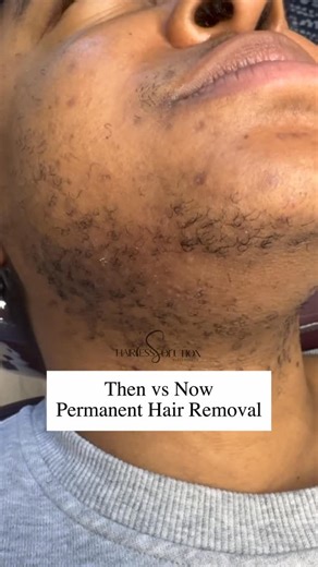 Hairless Solution Electrolysis on Instagram: "Electrolysis is the only FDA-approved method for permanent hair removal. Safe, effective, and life-changing. Click link in my bio to book / visit our website www.hairlesssolution.com ✅Follow @hairless_solution @hairless_solution #pcos #reels #laserhairremoval#fyp #esthetics #hormonalacne #viralreels #foryou #electrolysisatlanta #electrolysis #hairlesssolution #electrologist #atlelectrolysis"