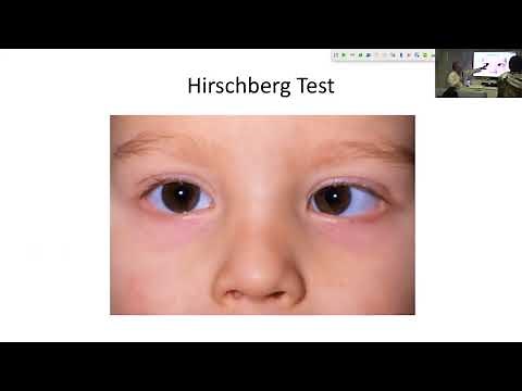 Lecture: Esotropia-Exotropia: Dr. Carlos Solarte