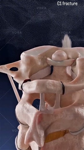 medical_animation | How do anterior and posterior arch C1 fractures affect spinal stability? C1 fractures, also known as atlas fractures, are a type of neck... | Instagram