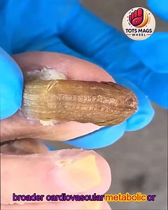 18K views · 156 reactions | Safe Best Care Practices for Diabetic Nails #WellnessSeniors #FootWellnessUSA #SimpleHealthTricks | Tots Mags Wheel | Facebook