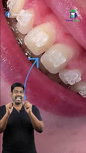 கிளிபுக்கு பிறகும் இடைவெளி இருக்குமா? - Incisal embrasure | Dr.Karthikeyan | Denta Kings