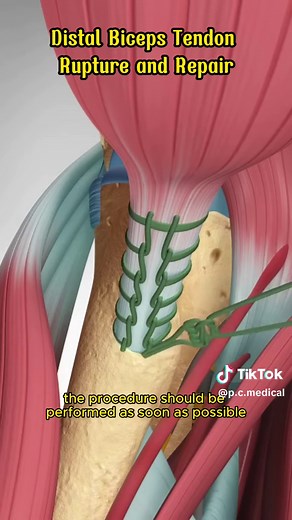 Distal Biceps Tendon Rupture: Causes and Repair Techniques