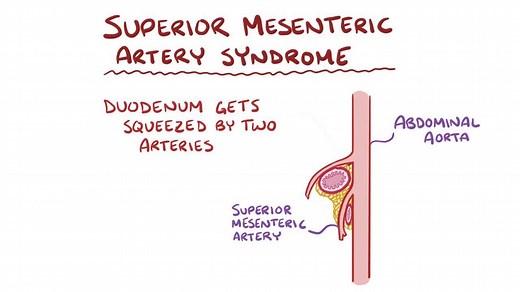 Video: Superior mesenteric artery syndrome - Video Explanation! | Osmosis | Osmosis