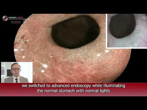 Gastric Metaplasia (English Subtitle) and Advance diagnostic endoscopy