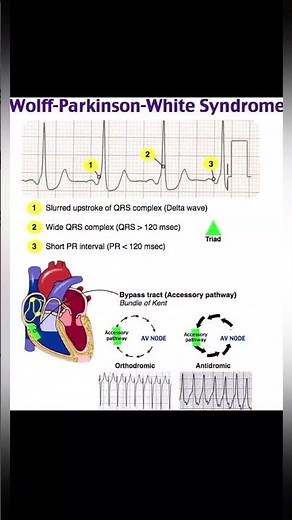 WPW Syndrome ECG Findings #ekg #cardiology