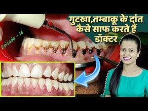 तंबाकू के दांत कैसे साफ करें | tobacco teeth cleaning in hindi | दांतों की सफाई Episode – 16