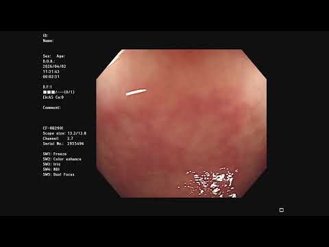Colonoscopy insertion video 27 @colonoscopy