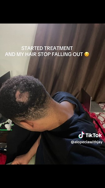 Living with “Alopecia Areata” created this page to give awareness to everyone cause I went through this journey a lot it’s very emotional 😭 to deal with just want you to know your not alone. More videos coming soon about treatment and medication .❤️☺️ #alopeciaareata #awareness #alopecia #videoviral #explore