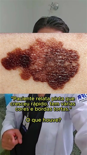 A pinta que cresceu rápido, tem várias cores e bordas tortas.