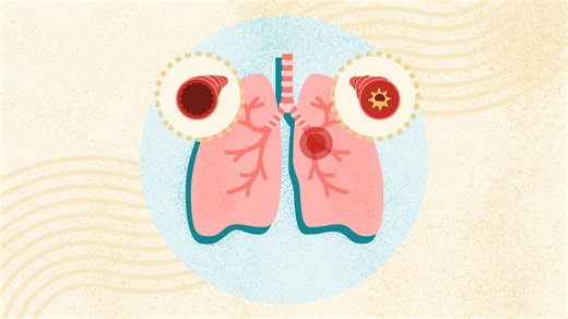 What Is Asthma?