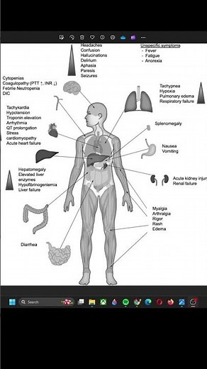 Cytokine Release Syndrome #meded #oncology #criticalcare #emergencymedicine #medicalschool