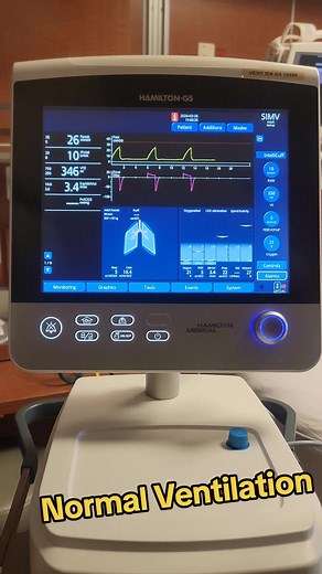 Ventilator Alarms: Understanding High and Low Alerts