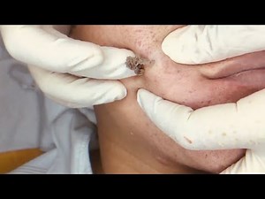 🔥 Pimple Popping 2020 Video| Super Acne shoots out| Blackheads removal| Acne removal|Acne treatment