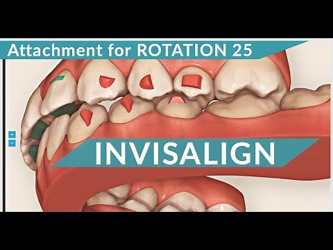 Attachment for rotation 25 (Invisalign) 🦷