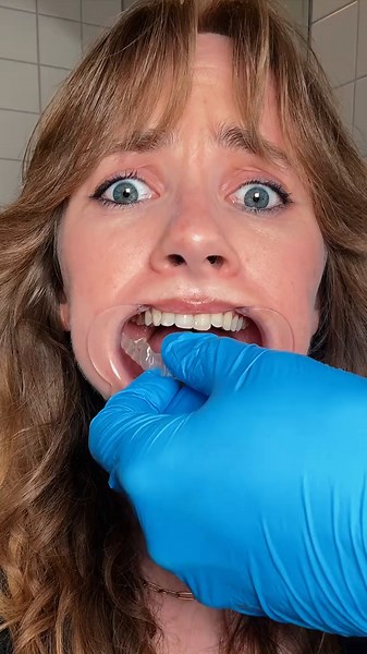 Effective Retainer Cleaning Hacks You Need to Try