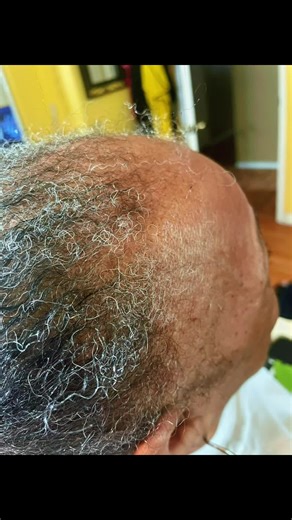 Alopecia Hairstyle to Cover Thin hair, Hairloss, & thin Edges #thinhair #hairloss #alopecia