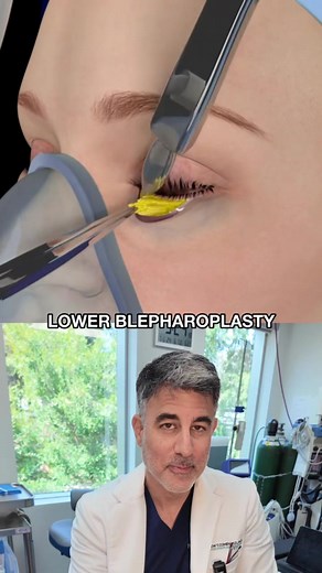 Ever wondered how lower eyelid surgery works? 👁️ This animation shows exactly how we smooth out under-eye bags and refresh the lower eyelid.