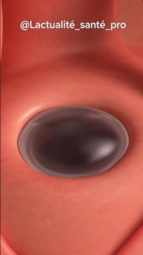 #cyst
