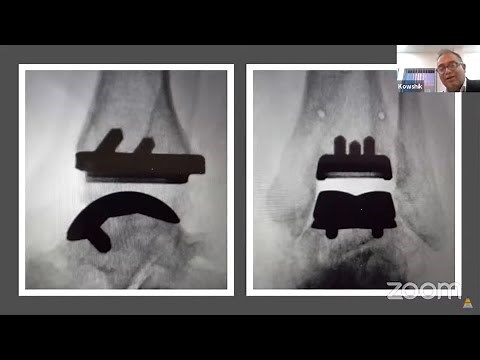 Total Ankle Replacement- an Overview