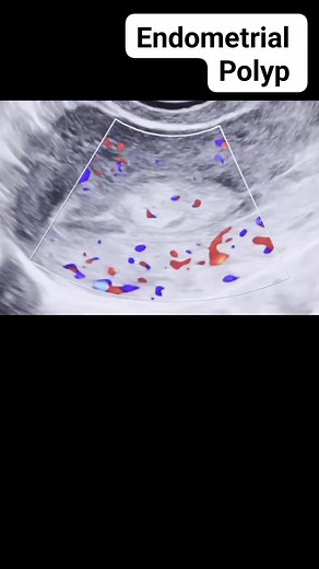661 reactions · 143 shares | Endometrial polyp on ultrasound #viralreelsシ #viralvideoシ #educationalreels #radiology #education #medical #ultrasound #polyp | Radiology Interesting | Facebook