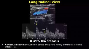 76 reactions · 15 shares | Carotid Artery Doppler Ultrasound...