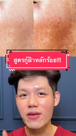 ไขความจริงเรื่องฝ้า พร้อมแนะนำเซรั่มลดฝ้า