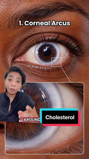Signs you have high cholesterol #cholesterol