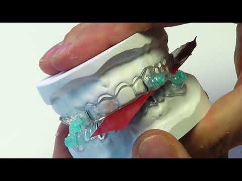 Silensor®-sl okklusale Gestaltung