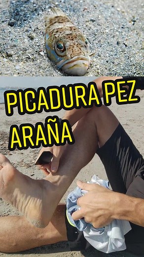 Picadura de pez araña ... Como debes actuar . #emergencias #urgencia #rescate #picaduras #salvarvidas #primerosauxilios #pezaraña #aprende #educacion
