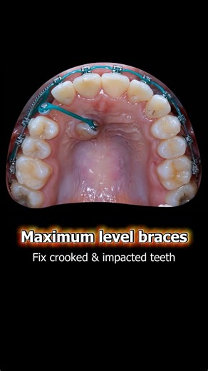 Maximum level braces, fix crooked teeth and pull out impacted teeth #braces #dentist #orthodontics
