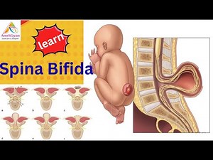 Spina Bifida Explained | Neonatal Nursing | AmritGyan
