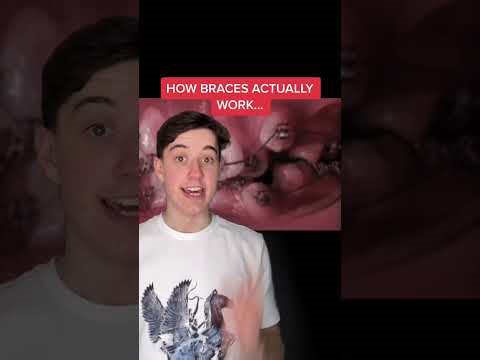 How dental braces gradually realign teeth over time